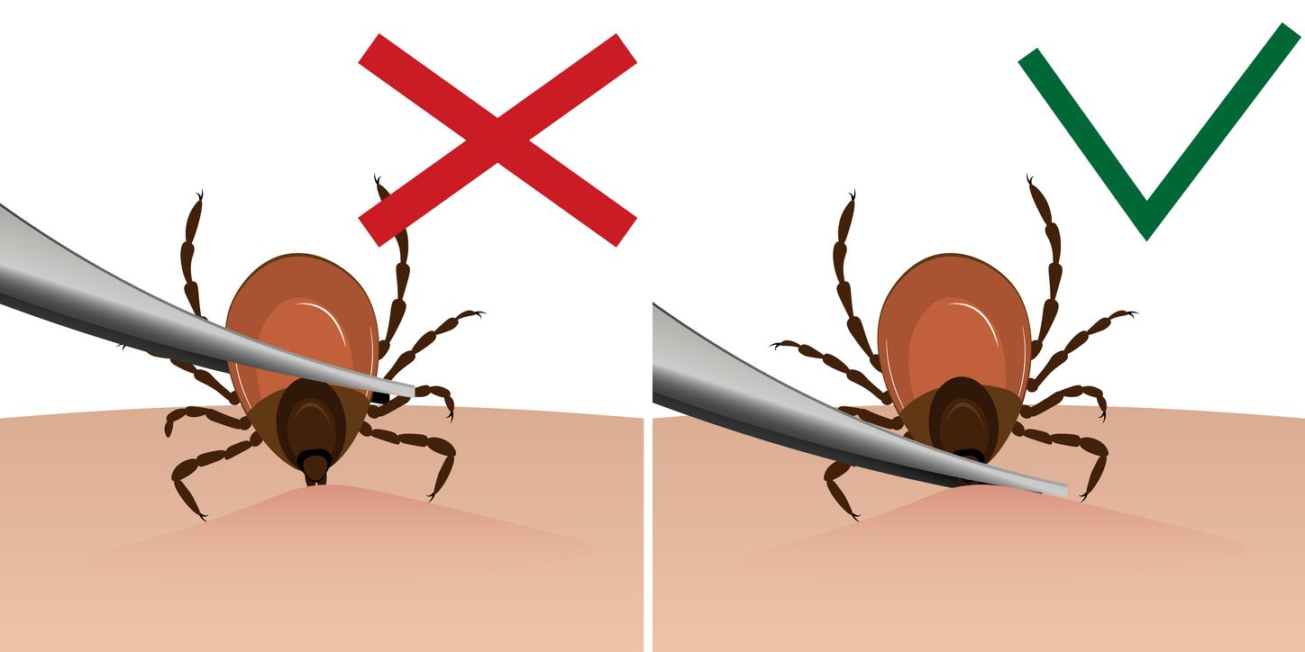 A graphic showing how to properly remove a tick